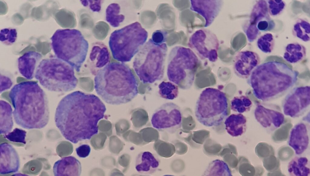 Abundante blastosis (presencia de blastos en sangre periférica) durante la crisis blástica de una leucemia.